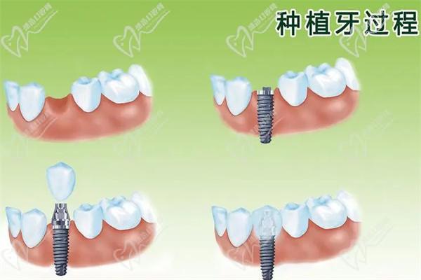韩国登腾种植牙