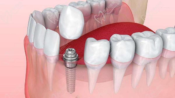 瑞士SIC种植体怎么样