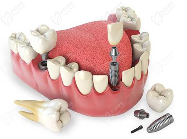 瑞士SIC种植体怎么样使用寿命