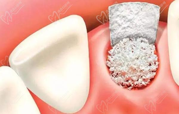 瑞士SIC种植体怎么样缺点