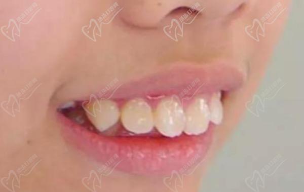 儿童牙齿早期矫正