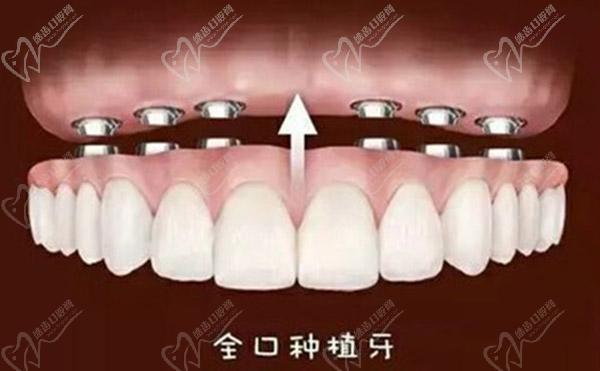 全口种植