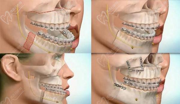 吴国平做各类颌面畸形正颌手术的特点