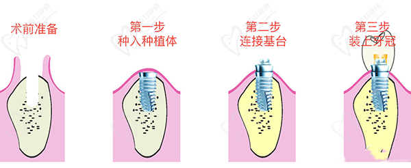 种植牙过程