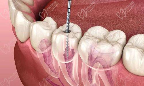 二次根管治疗很麻烦吗