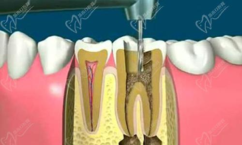 根管治疗后隐隐作痛怎么办？