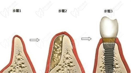 上海艾德口腔医院种植牙多少钱一颗？