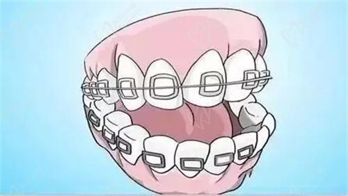 上海艾德口腔医院牙齿矫正价格多少钱？