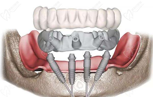 全口即刻种植牙是一种现代牙齿修复技术