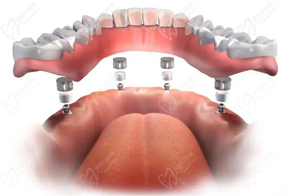 全口即刻种植牙是一种现代牙齿修复技术