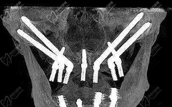 全口即刻种植牙是一种现代牙齿修复技术