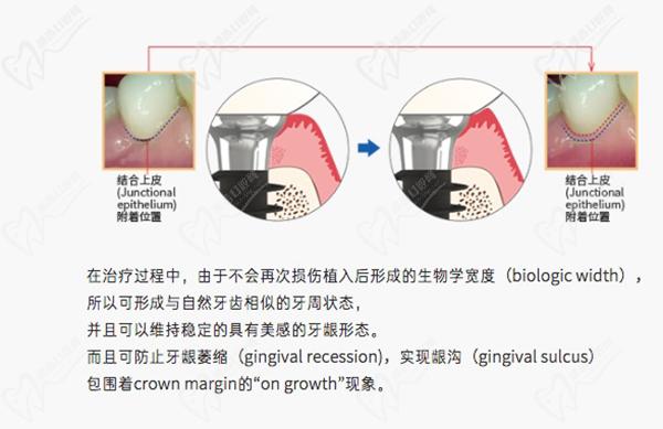 韩国IBS种植牙多少钱一颗？还想问韩国ibs种植牙是什么材质的