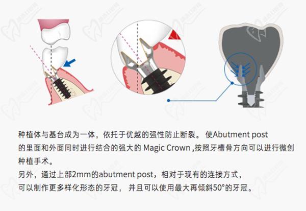 韩国IBS种植牙多少钱一颗？还想问韩国ibs种植牙是什么材质的