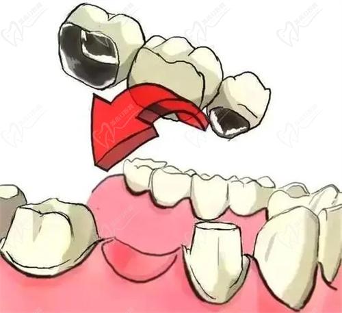 广州穗华口腔医院镶牙，固定牙齿，安装假牙技术优势