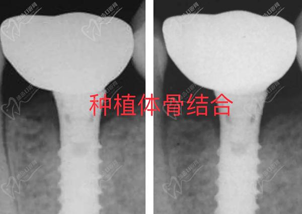 哪国的种植牙适合中 国人种植?韩国|瑞典|瑞士等种植体优势明显