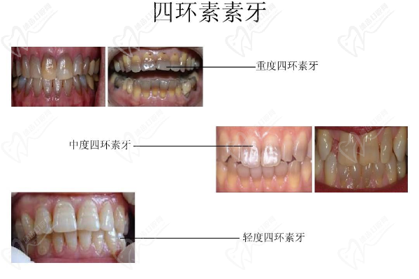 四环素牙美白价格