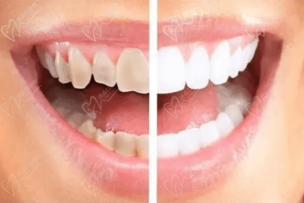 四环素牙齿可以治吗