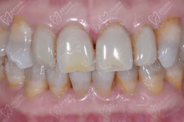 四环素牙齿可以治吗