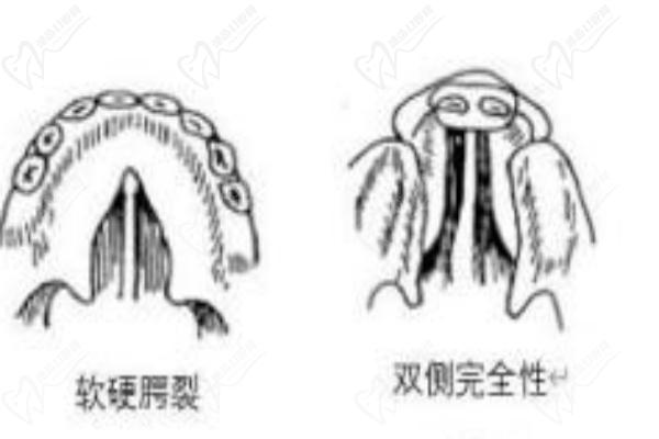 唇腭裂龅牙齿图片