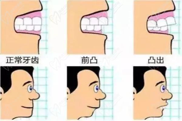 各阶段龅牙是什么样子的
