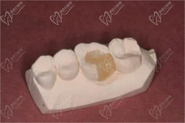 树脂嵌体补牙