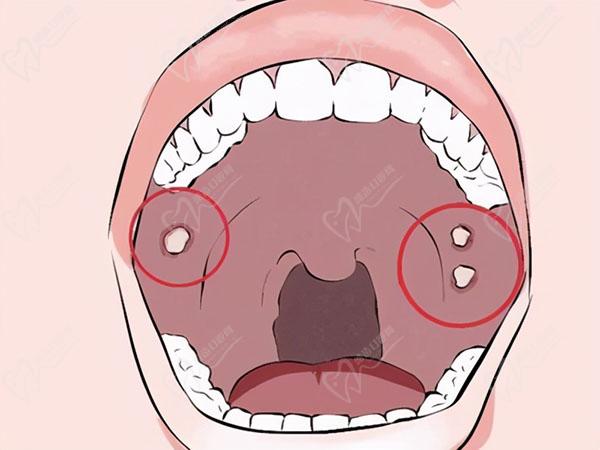 小孩牙龈长脓包怎么治疗