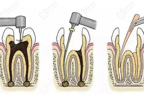 儿童牙齿根管治疗的具体步骤有哪些