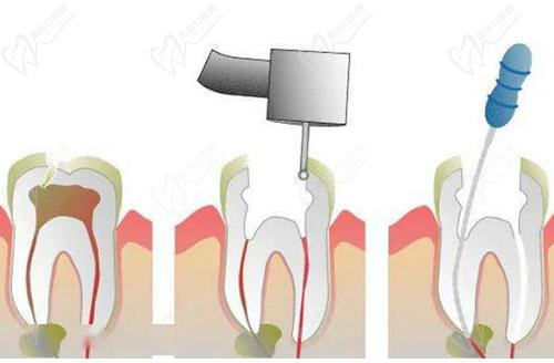 儿童牙齿根管治疗的具体步骤有哪些