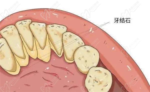 牙结石