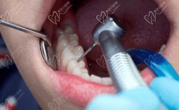 口腔治疗 口腔治疗