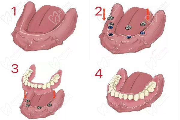 球帽种植附着体修复义齿流程