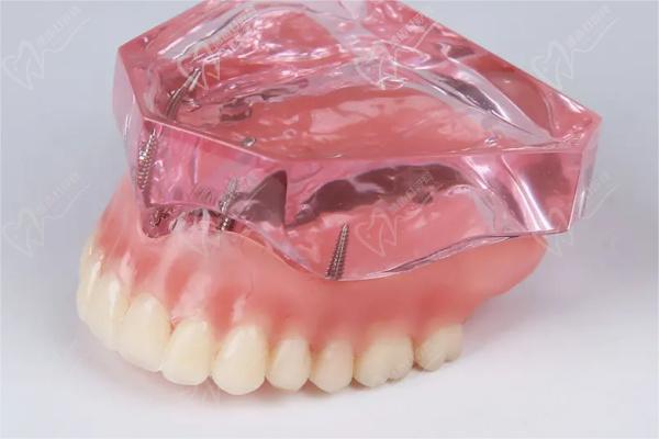 球帽种植修复义齿牙模