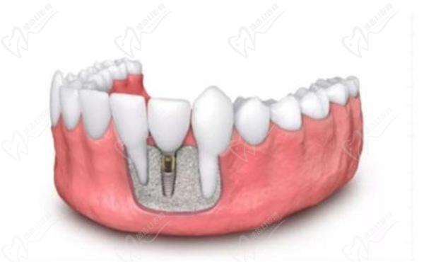 种植牙植骨