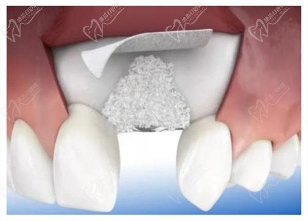种植牙植骨