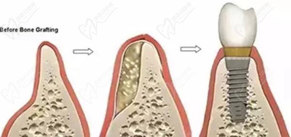 种植牙植骨