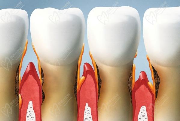 牙齿缝隙大有什么治疗方法吗