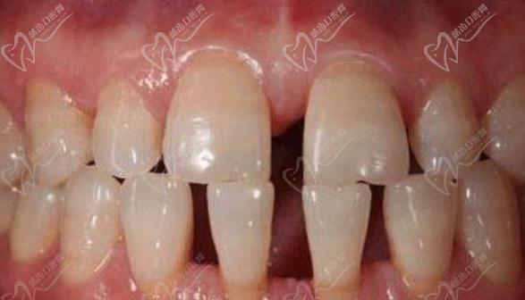 牙齿缝隙大有什么治疗方法吗