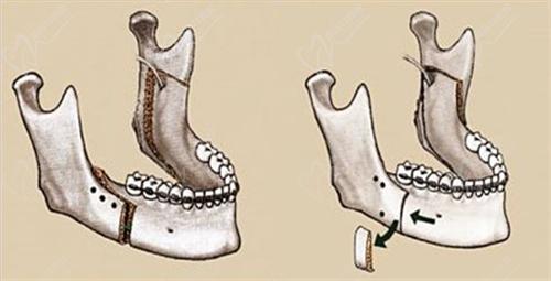 广州广大正颌要数何锦泉医生