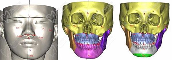 广州广大正颌要数何锦泉医生