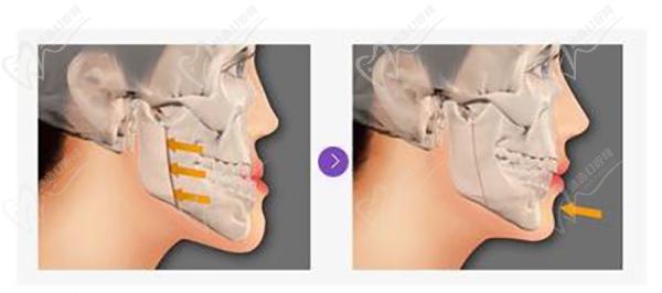 广州广大正颌要数何锦泉医生