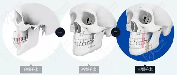 广州广大医院正颌手术技术好！且可以使用医 保报销