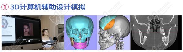 何锦泉正颌手术采用的是全新3D数字化颌面技术