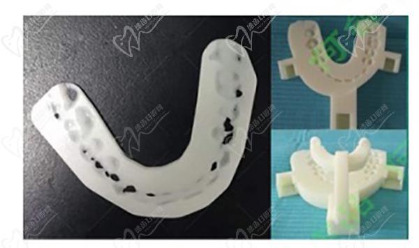 何锦泉正颌手术通过3D打印导板定位截骨