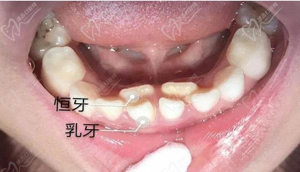 儿童双排牙