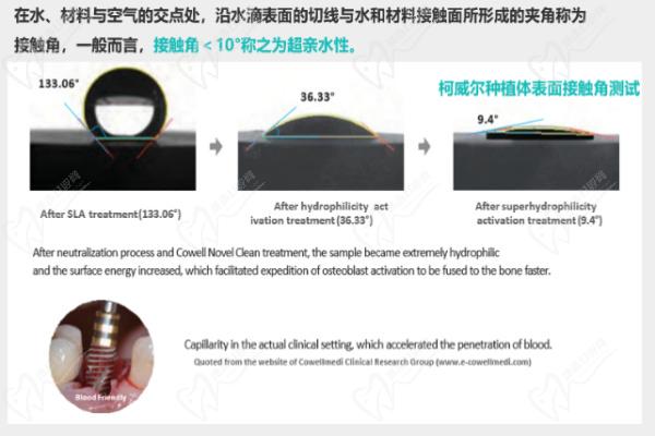 韩国柯威尔种植体独特设计