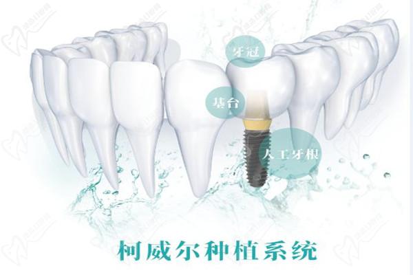 韩国柯威尔种植系统