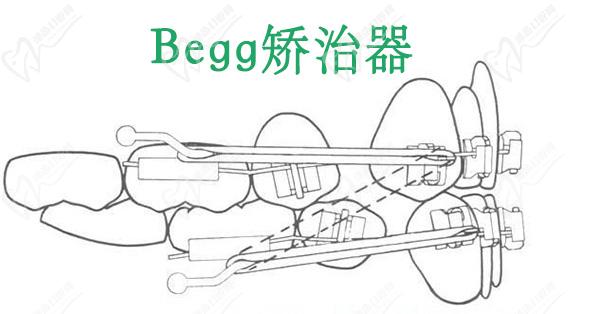 Begg矫治器图片