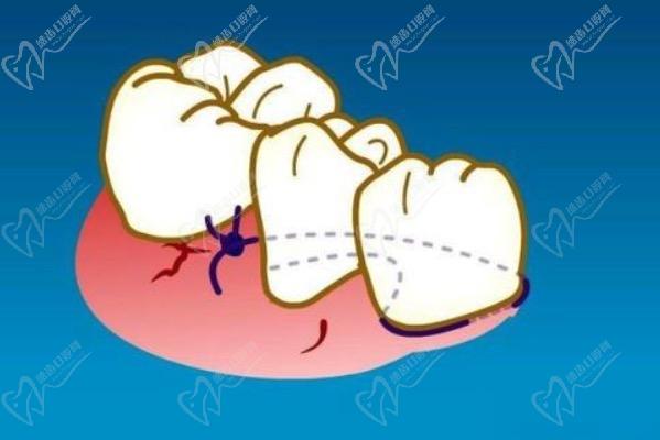 牙周炎会引起牙神经痛吗？