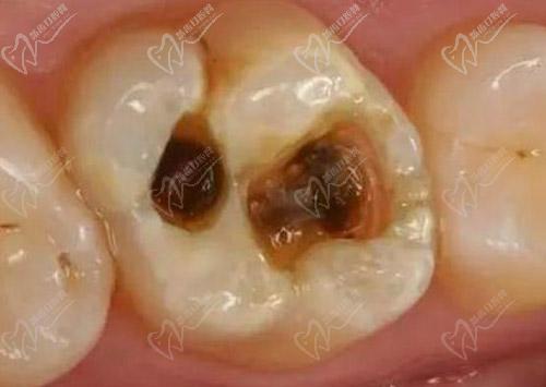 复合树脂和固体树脂补牙的区别