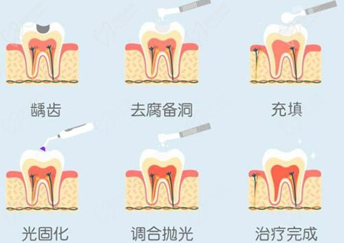 复合树脂和固体树脂补牙多少钱一颗